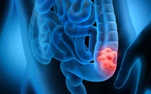 The Biggest Myths About Colon Cancer