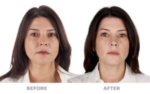 The Advantages of PRP Microneedling