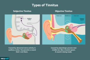 Hearing loss due to tinnitus is possible.