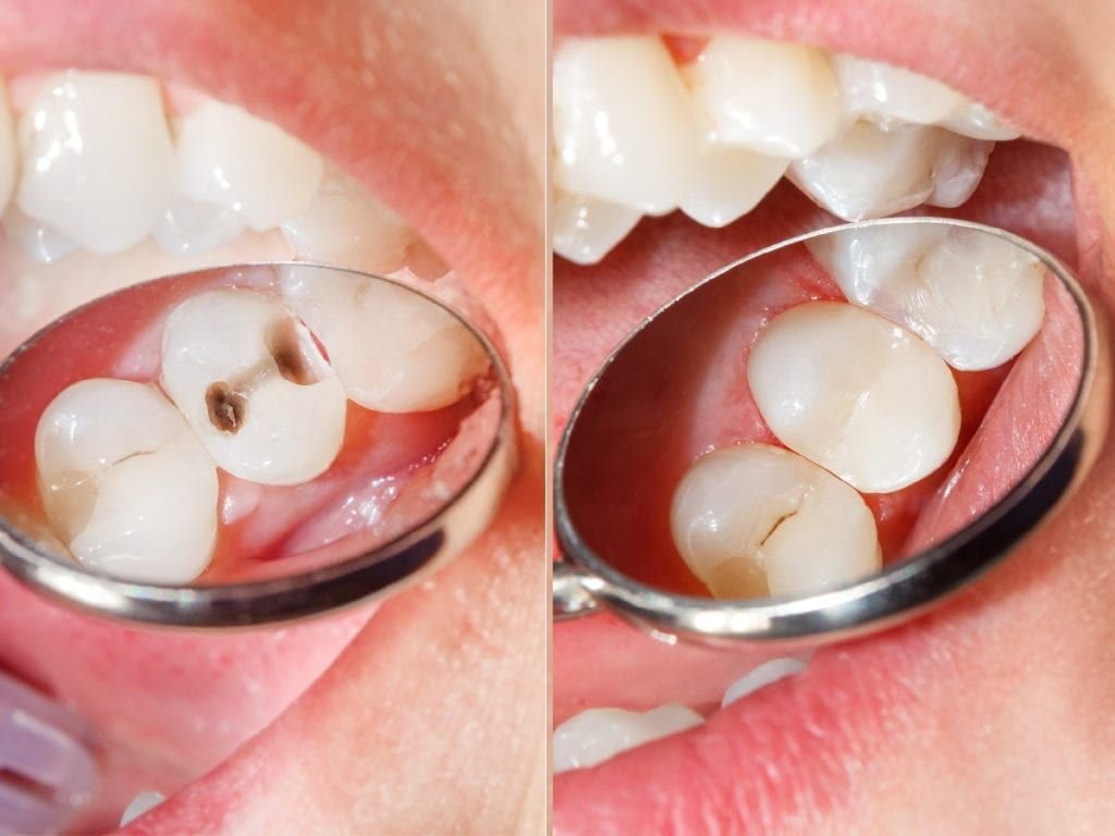 Top 11 Arguments for Using Resin Fillings in 3023