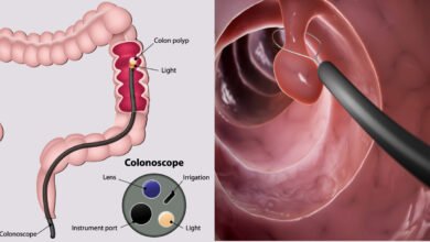 The Biggest Myths About Colon Cancer