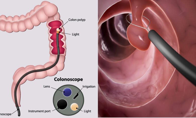 The Biggest Myths About Colon Cancer