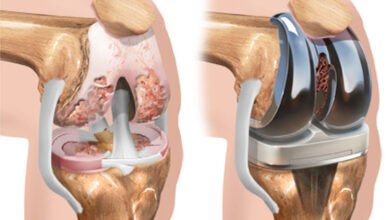 What You Should Know About Knee Replacement