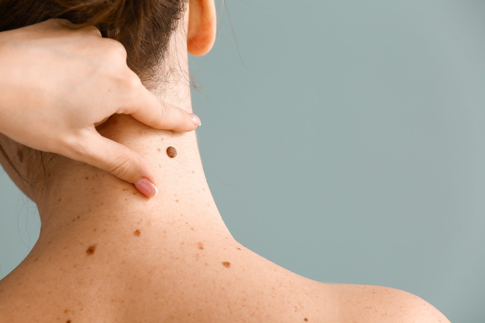 Important Information About Seborrheic Keratosis