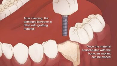 What to Know About Bone Grafting Techniques