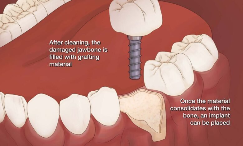 What to Know About Bone Grafting Techniques