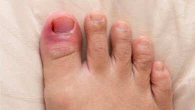 Causes Understanding Ingrown Toenails