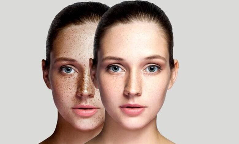 Skin Pigmentation