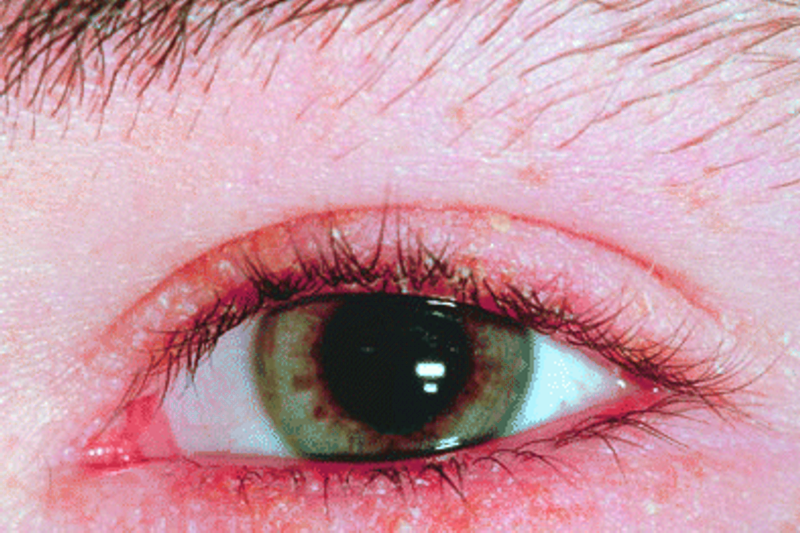 dry eye syndrome